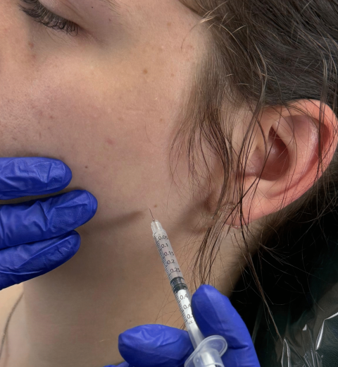 Botox Injection – 2 Botox Injection - 2